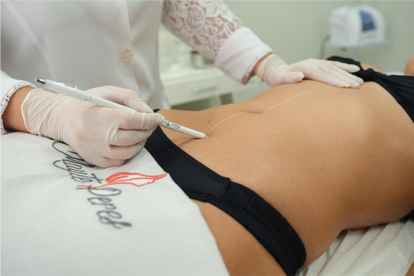 Centro Estético Dra. Mayte Peres - Tudo sobre hidrolipoclasia