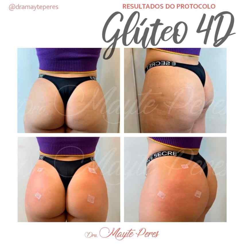 Centro Estético Dra. Mayte Peres - Resultado Glúteo 4D