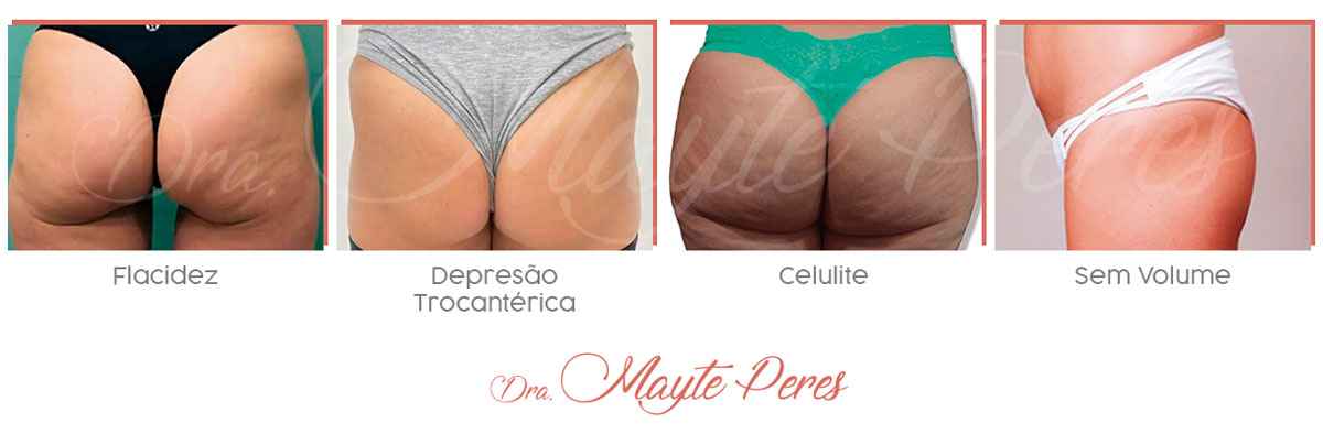 Centro Estético Dra. Mayte Peres - Tipos de bumbum