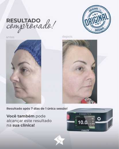 Centro Estético Dra. Mayte Peres - Resultado Endolaser