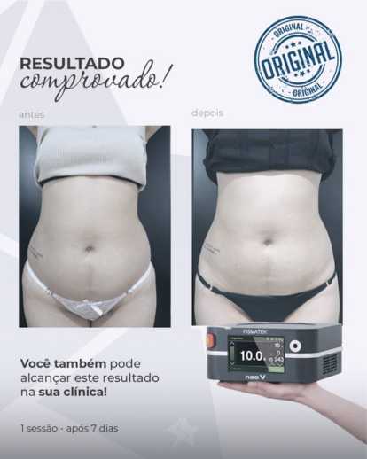 Centro Estético Dra. Mayte Peres - Resultado Endolaser