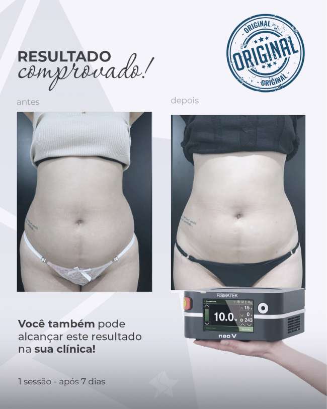 Centro Estético Dra. Mayte Peres - Resultado Endolaser