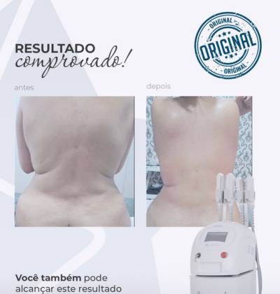 Centro Estético Dra. Mayte Peres - Resultado Criolipólise 