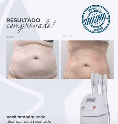 Centro Estético Dra. Mayte Peres - Resultado Criolípólise 